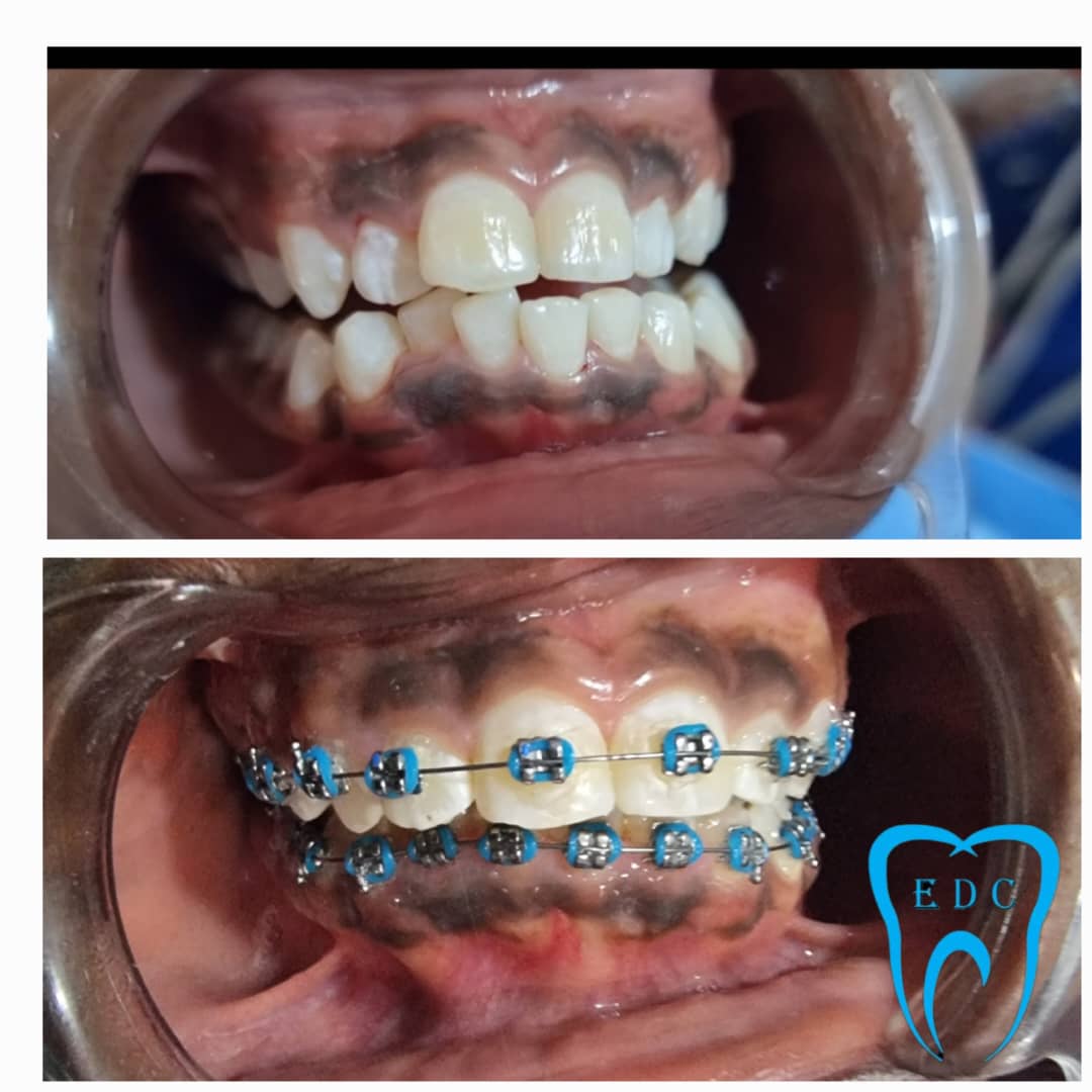 teeth braces