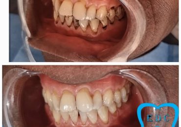 Scaling and polishing