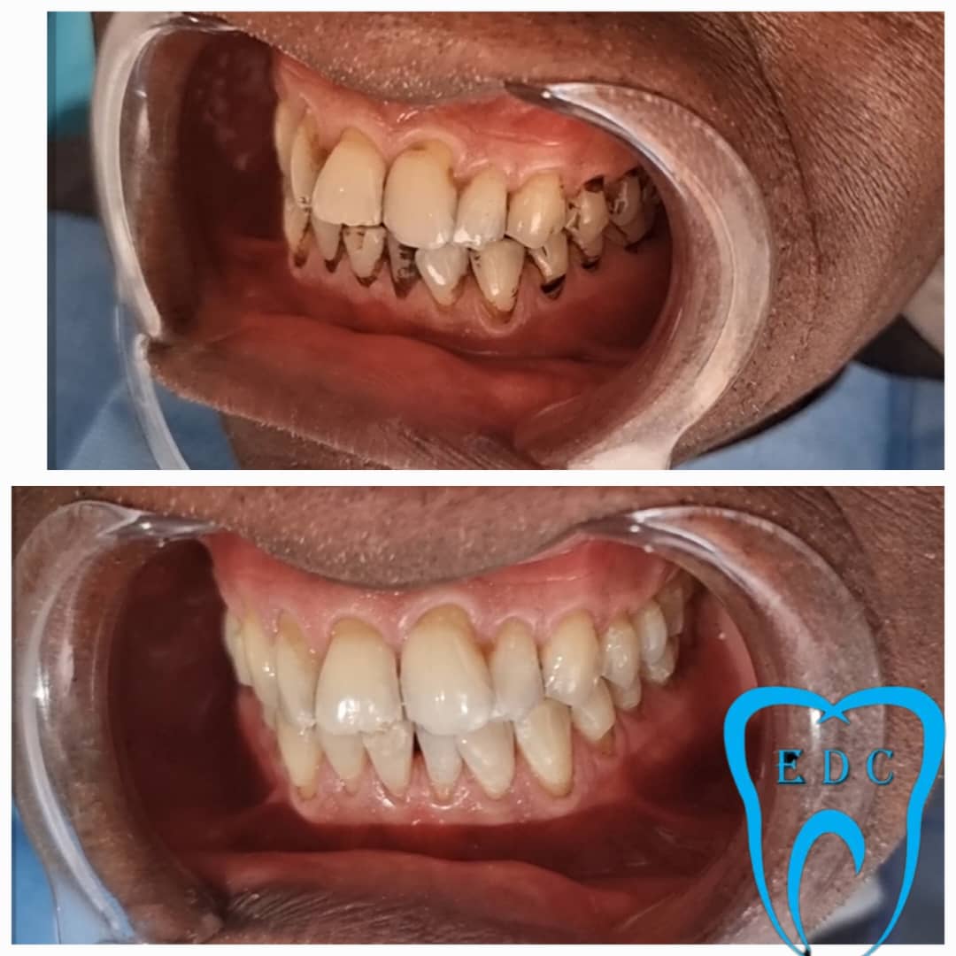 Scaling and polishing