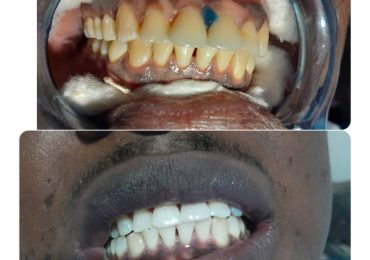 teeth cleaning elis dental care