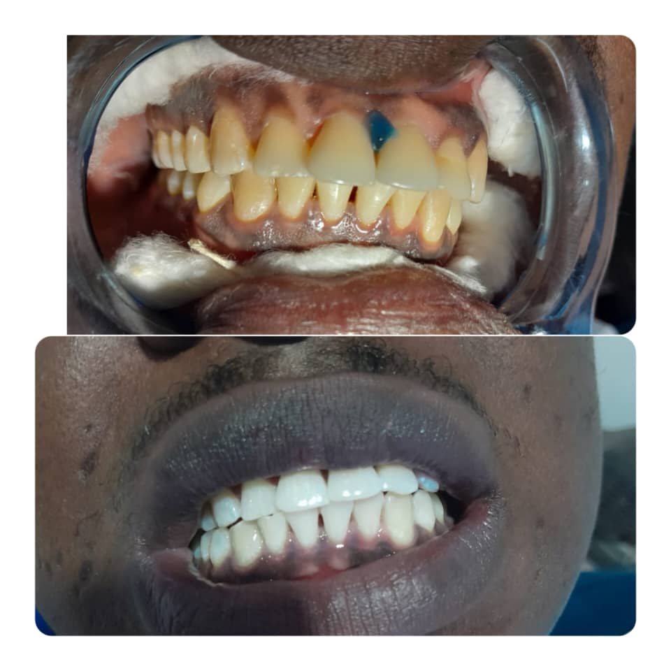 teeth cleaning elis dental care