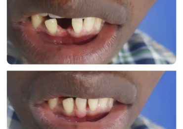 tooth replacement
