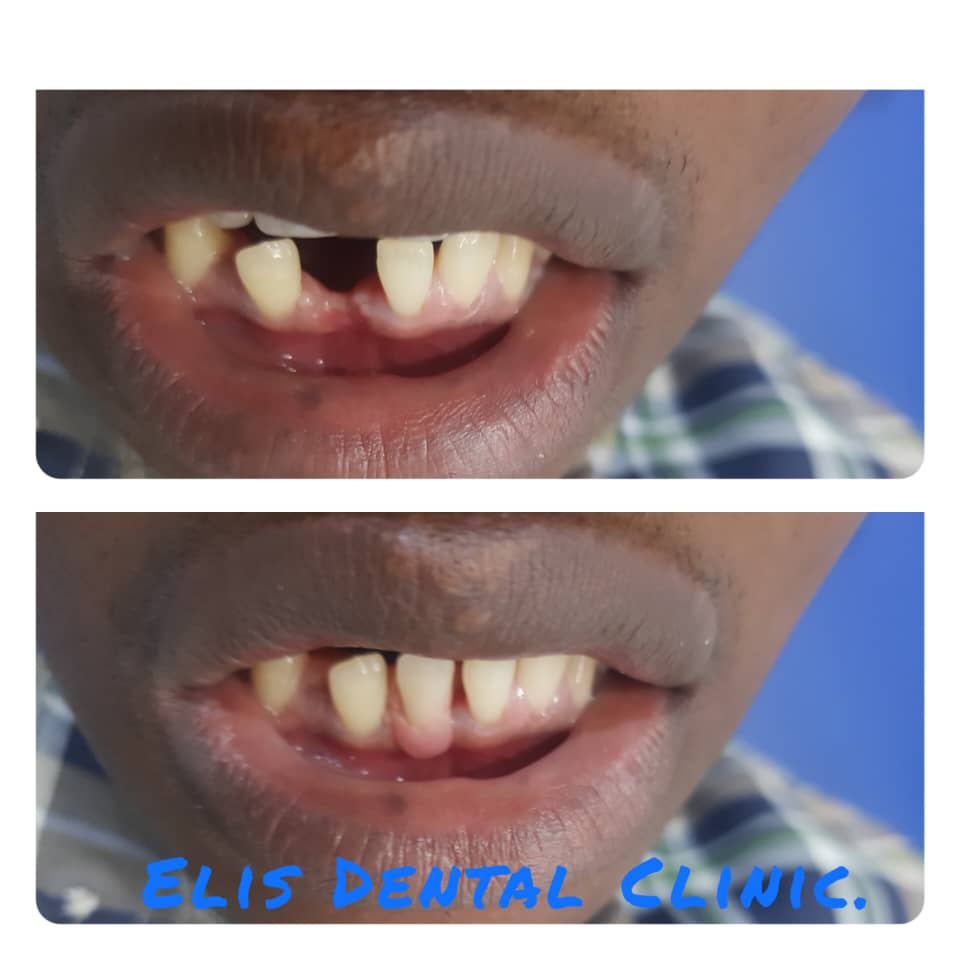 tooth replacement